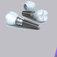 Dental Implants in Puerto Vallarta - Cost, Clinics, Dentists